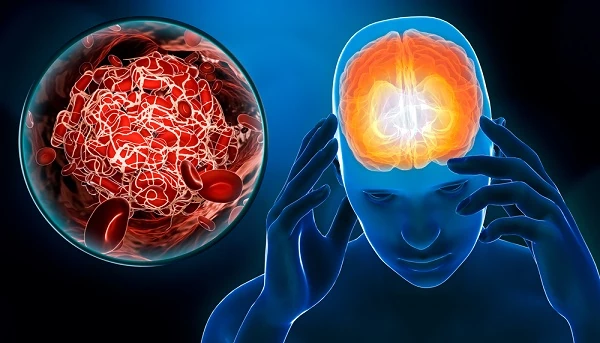 Man,Suffering,Of,A,Cerebrovascular,Accident,Or,Stroke,Or,Brain