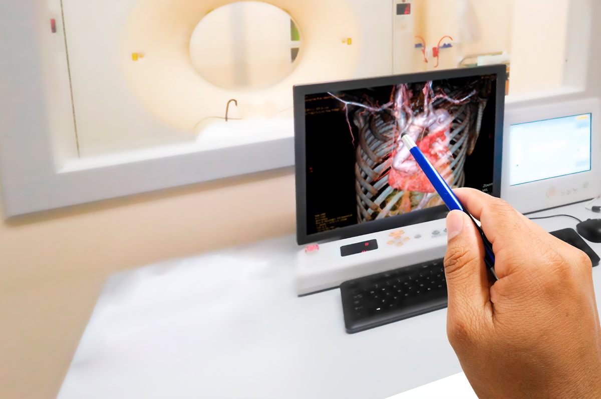Angiotomografia Computadorizada Coronariana