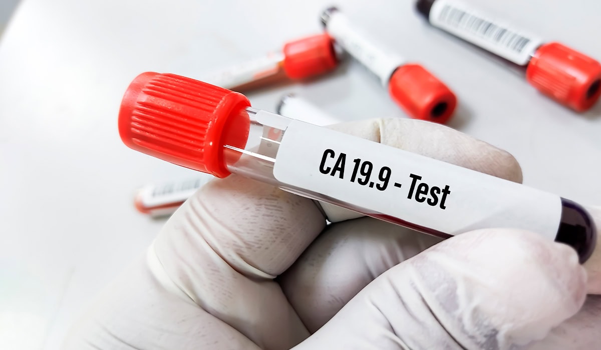 Tudo de ensaio com coleta de sangue para analise de exame de ca-19-9
