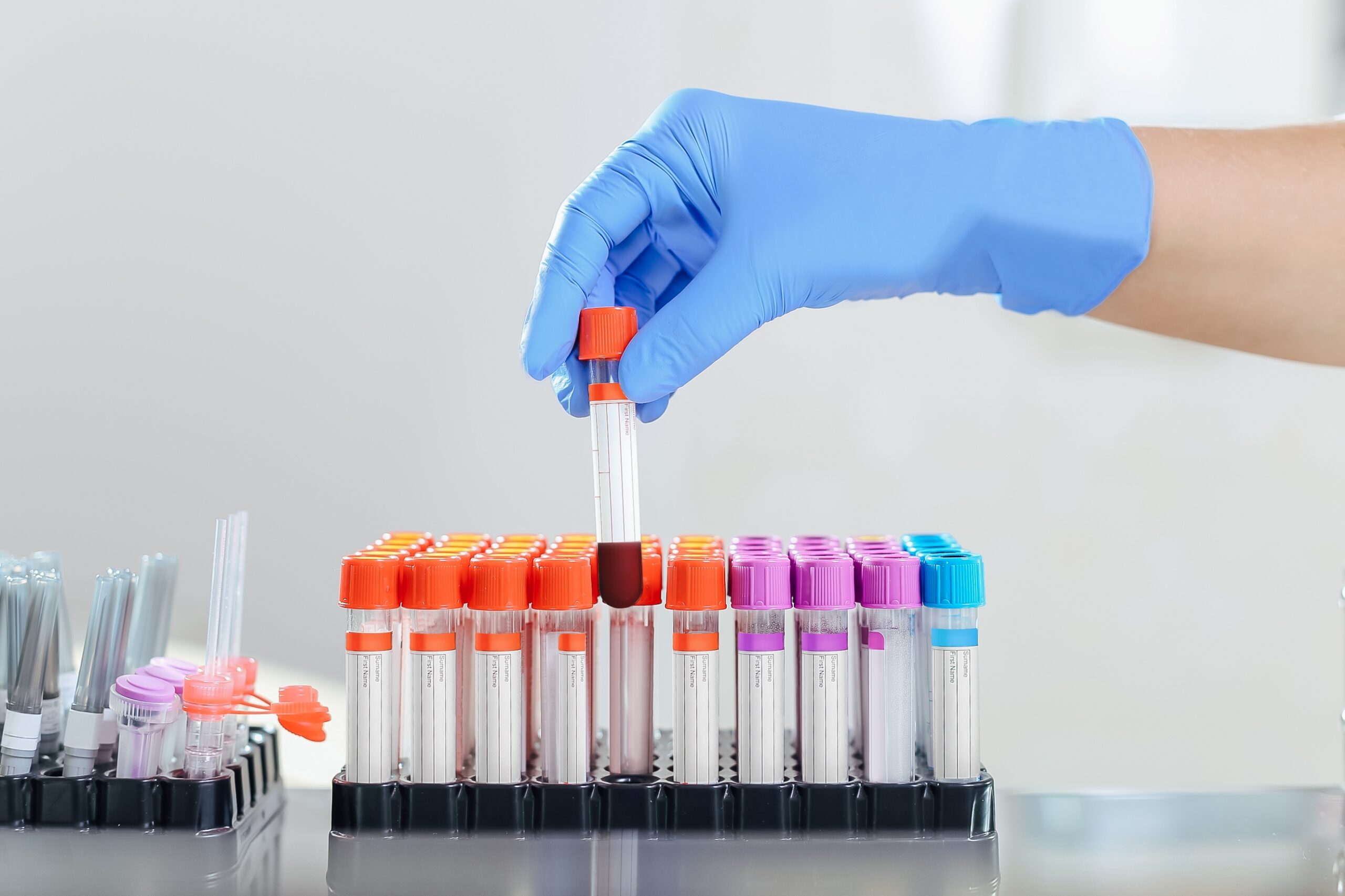 Mão com luva pegando um tubo de ensaio com sangue entre vários tubos organizados em suportes de laboratório. Mão com luva pegando um tubo de ensaio com sangue entre vários tubos organizados em suportes de laboratório.