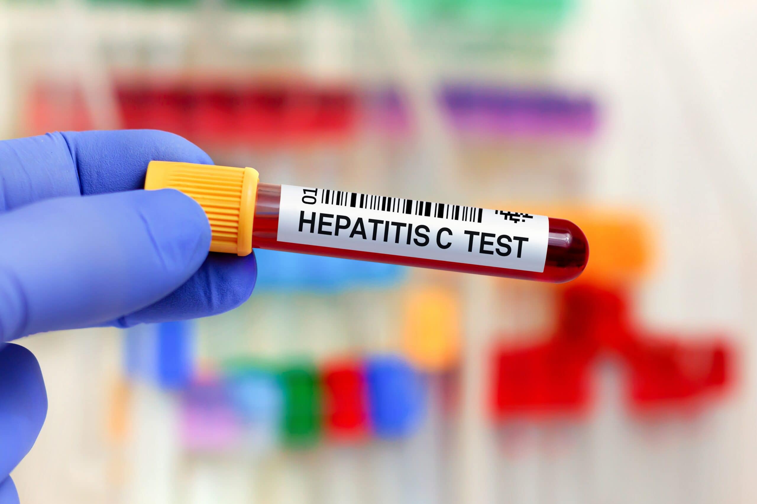 TUBO DE ENSAIO COM SANGUE PARA EXAME DE HEPATITE C TUBO DE ENSAIO COM SANGUE PARA EXAME DE HEPATITE C
