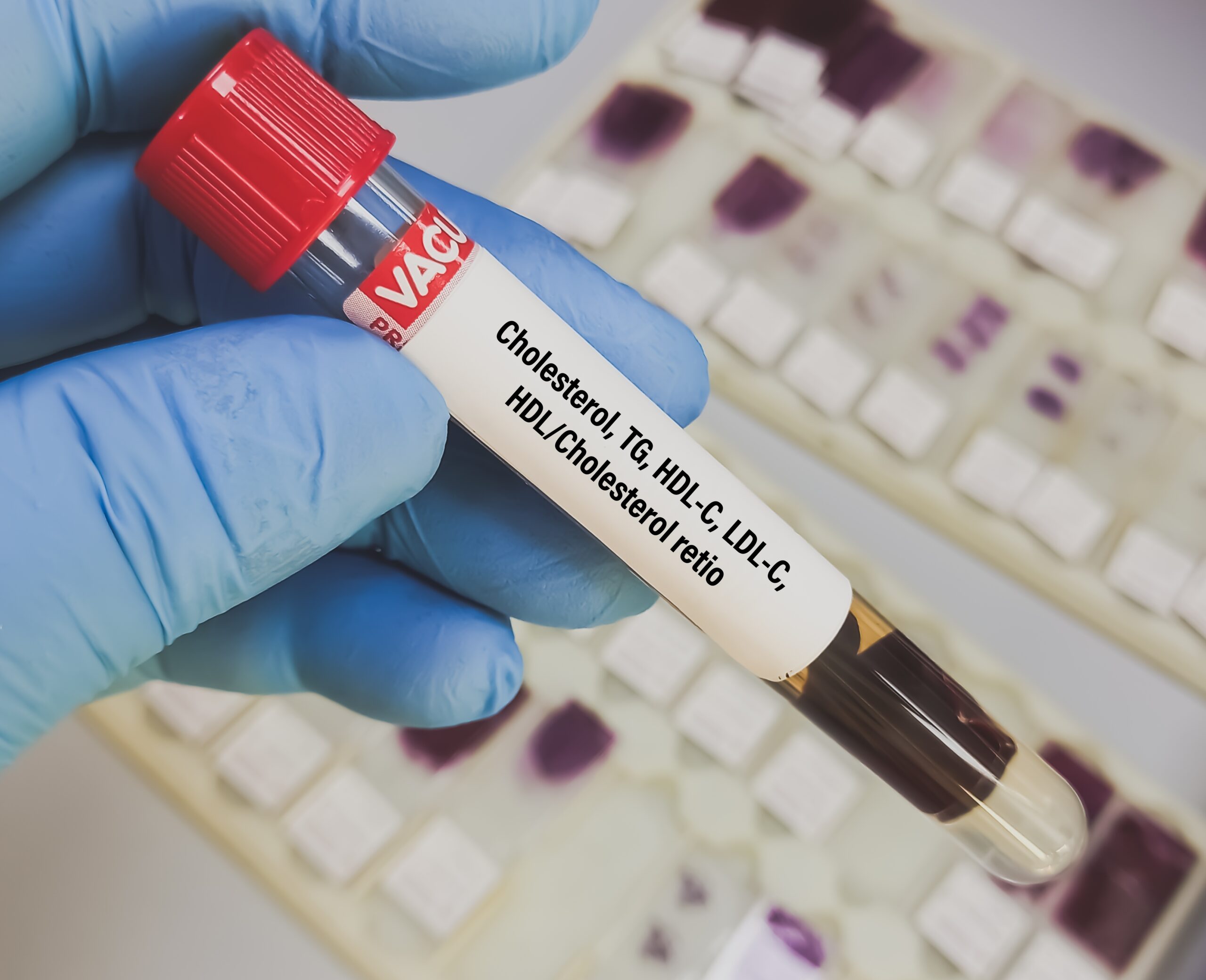 Tubo de ensaio com sangue para exame de HDL Tubo de ensaio com sangue para exame de HDL