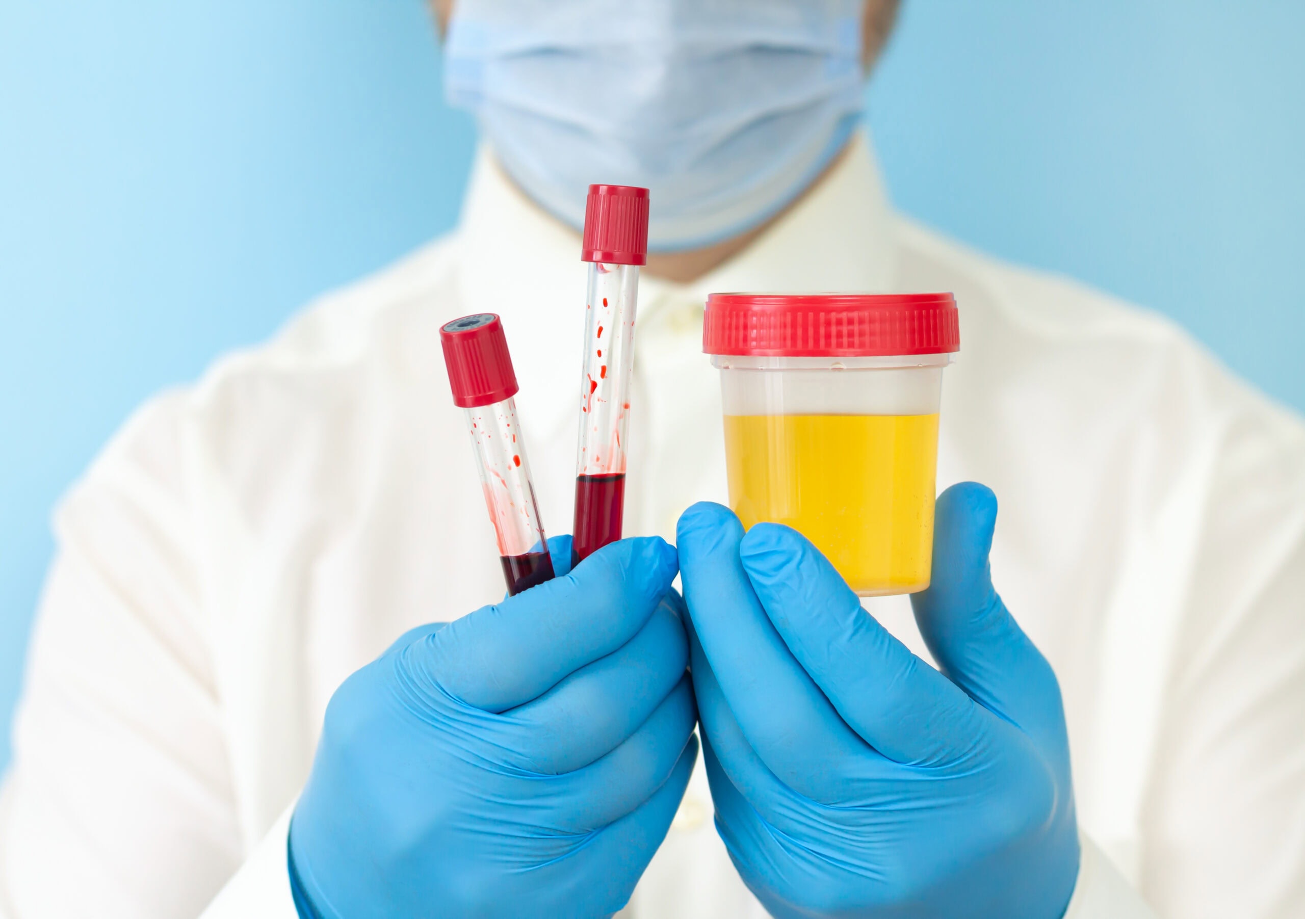 Profissional da saúde segura amostras de sangue e urina para exames laboratoriais, usando luvas azuis e máscara facial.