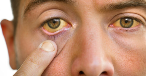 pessoa com olhos amarelados, um dos sintomas da doença
