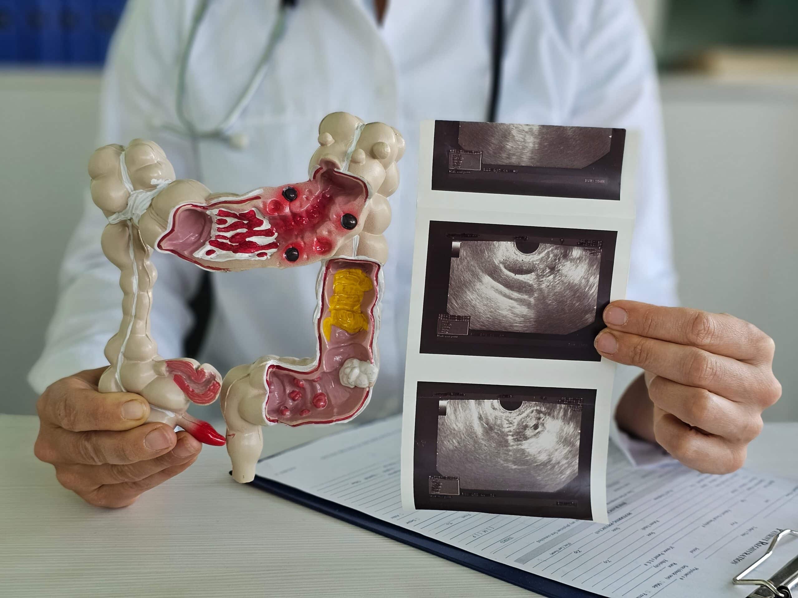 Médico segura modelo de intestino grosso com lesões e exames de imagem, sugerindo investigação de doenças intestinais.