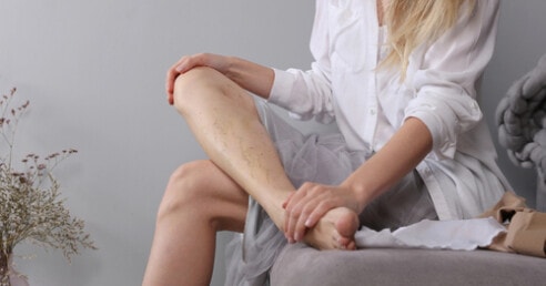 mulher de perna dobrada observa vasinhos em sua perna enquanto coloca uma mão em seu joelho e outra apoia o pé