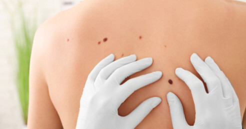 mãos de médica com luvas examinando pintas ou manchas na pele das costas de uma pessoa