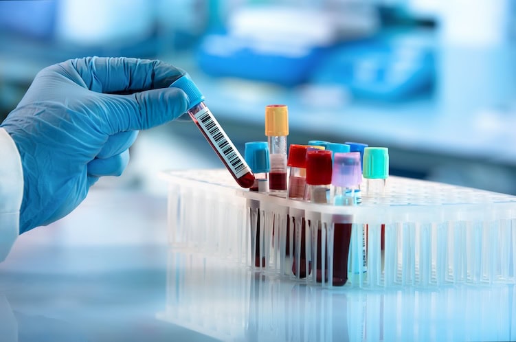 Mão de médico pegando um tubo de amostra de sangue de um suporte, com máquinas de análise ao fundo no laboratório.