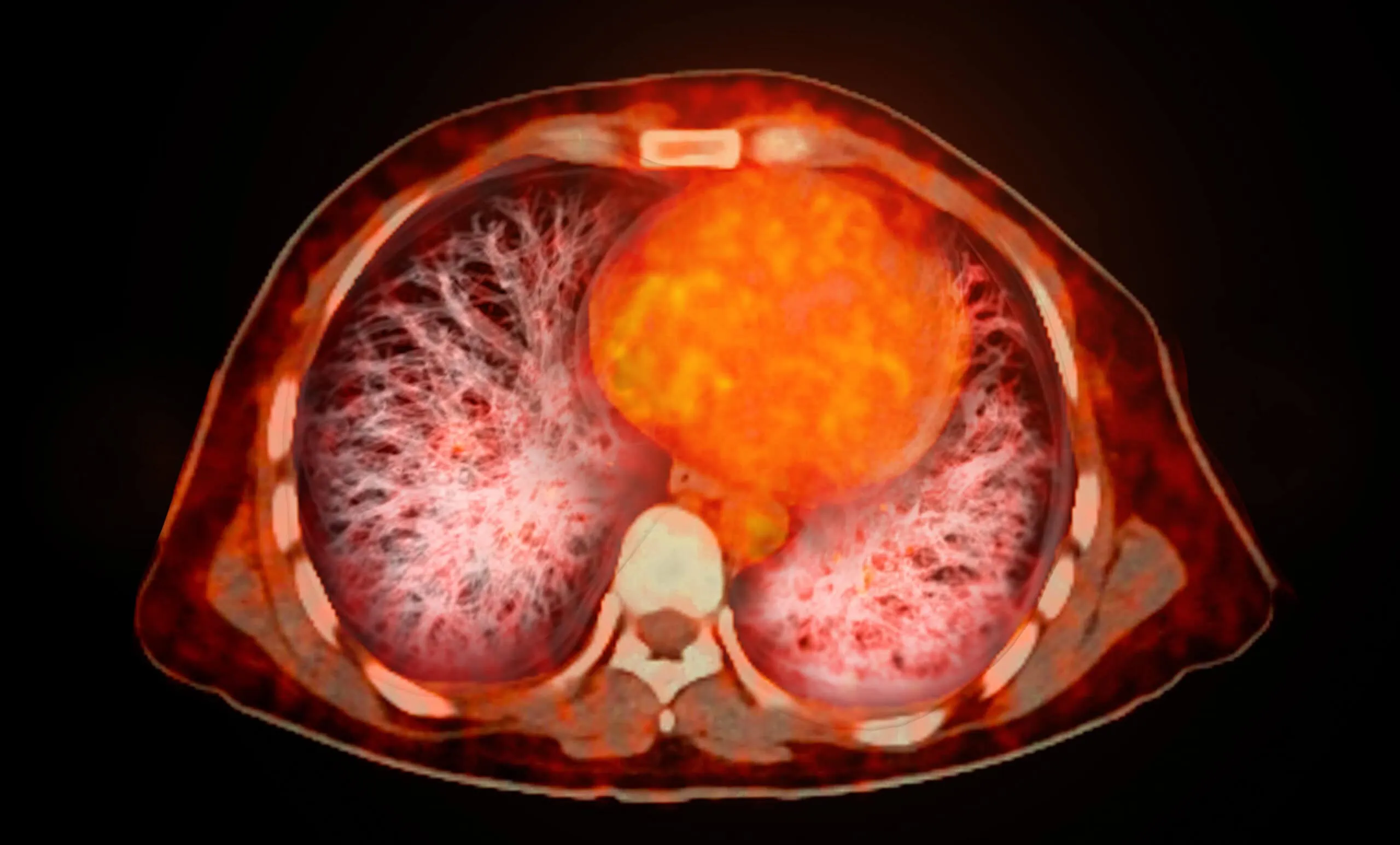 A PET-CT scan image is a diagnostic visualization combining Positron Emission Tomography (PET) and Computed Tomography (CT) for Helps in finding cancer recurrence.