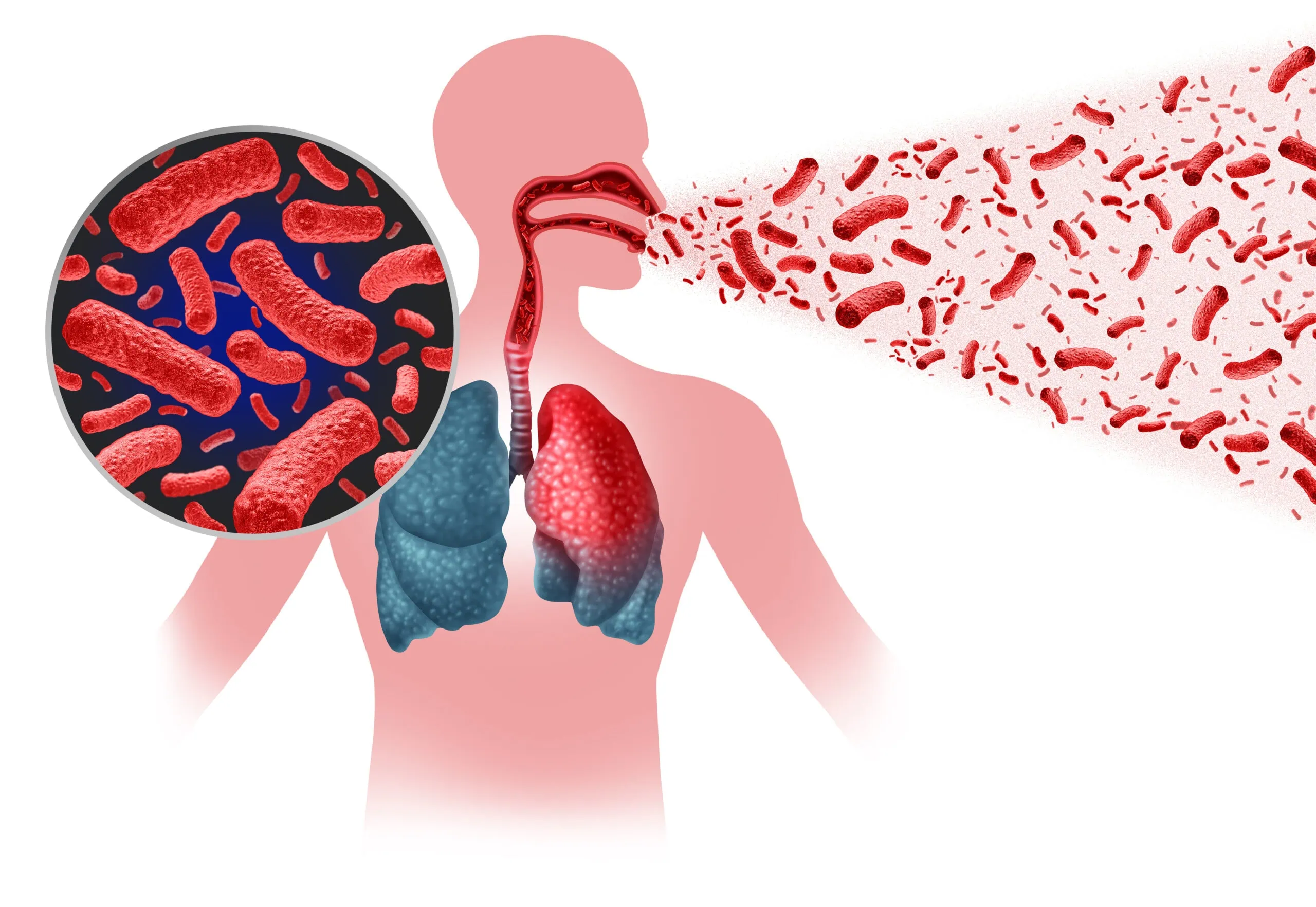 Tuberculosis infection Teste Cpert MTB XDR tuberculose