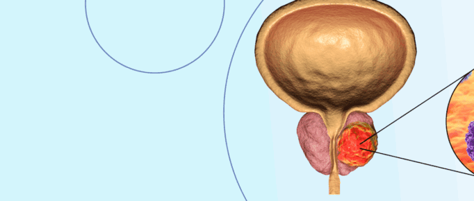PET-CT PSMA: uma importante ferramenta na avaliação do câncer de próstata
