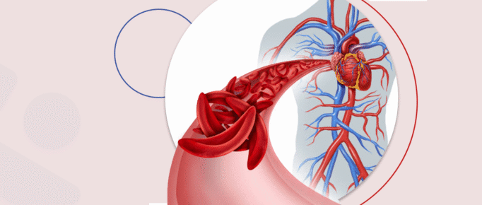 Homocisteína Alta: O que você precisa saber