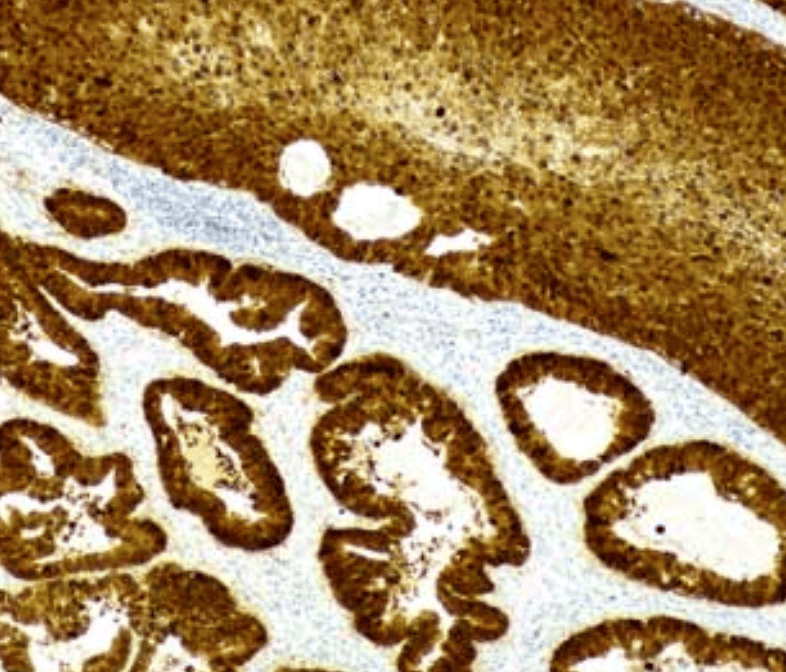 Figura – Imunoexpressão em bloco (forte e difuso) do marcador p16 no epitélio escamoso evidenciando HSIL sobreposto em áreas glandulares também positivas de Adenocarcinoma in situ associados ao HPV. Figura – Imunoexpressão em bloco (forte e difuso) do marcador p16 no epitélio escamoso evidenciando HSIL sobreposto em áreas glandulares também positivas de Adenocarcinoma in situ associados ao HPV.
