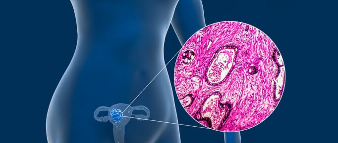Biópsia e exame imuno-histoquímico no câncer de colo uterino