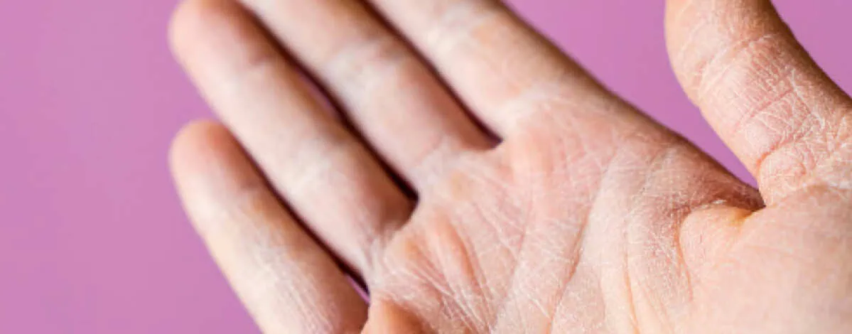 Mão com pele ressecada e textura áspera, ilustrando sinais comuns de queratose, como espessamento e descamação na superfície da pele.