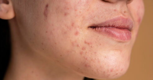 Rosto jovem com quadro de acne.