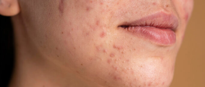 Rosto jovem com quadro de acne.