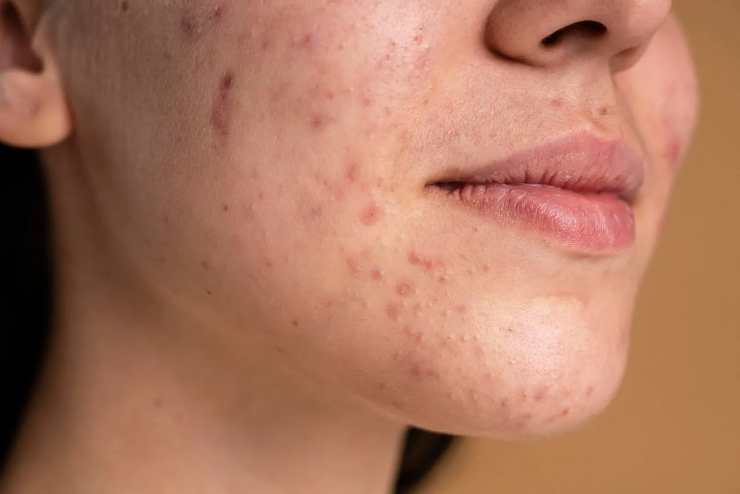 Rosto jovem com quadro de acne.
