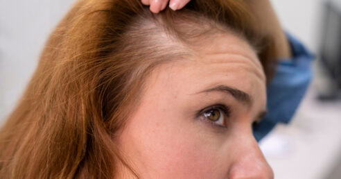 Mulher com queda de cabelo considerável, que pode ser um quadro de alopecia androgenética.