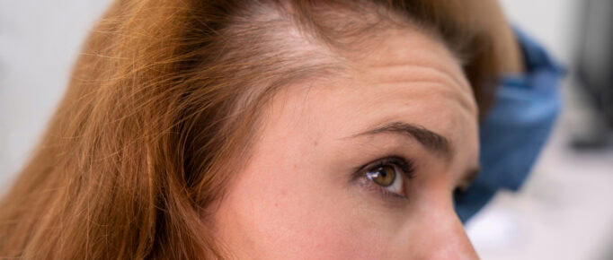 Mulher com queda de cabelo considerável, que pode ser um quadro de alopecia androgenética.