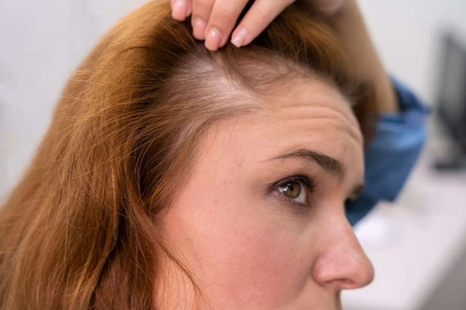 Mulher com queda de cabelo considerável, que pode ser um quadro de alopecia androgenética.