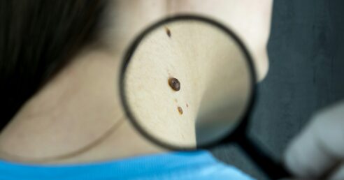 Imagem mostra uma pessoa (dermatologista) com uma lupa na mão investigando manchas de pele no pescoço de um paciente.