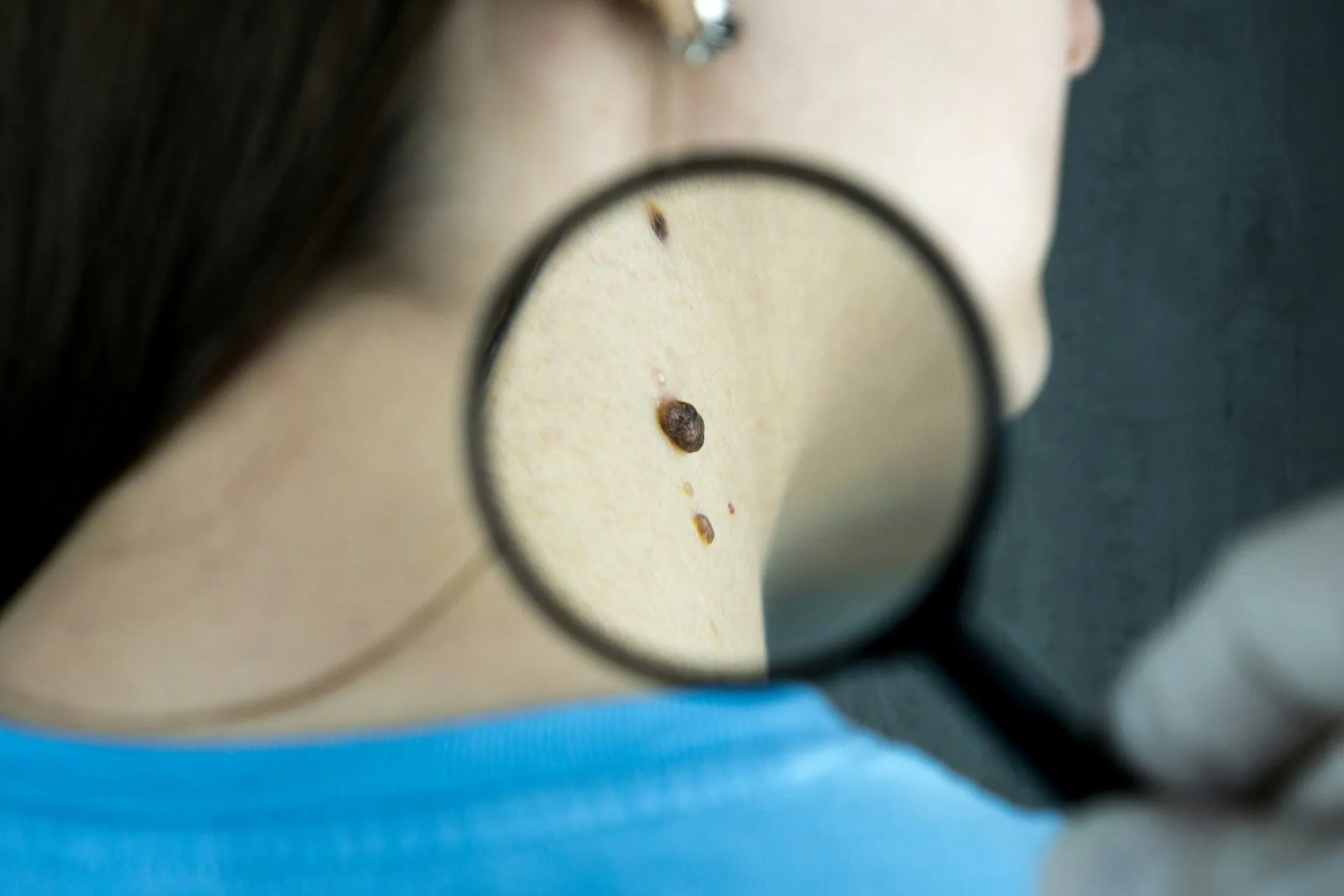 Imagem mostra uma pessoa (dermatologista) com uma lupa na mão investigando manchas de pele no pescoço de um paciente.
