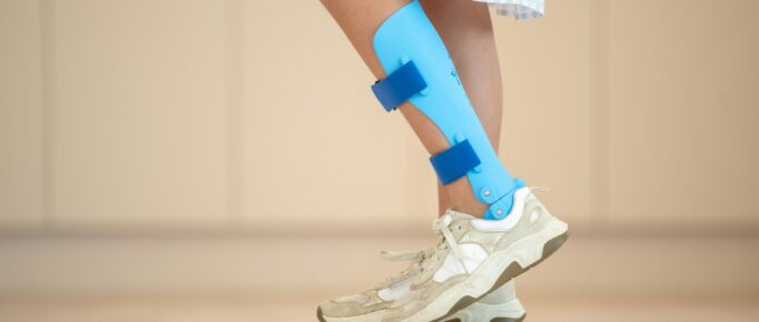 A imagem mostra as pernas de uma pessoa caminhando com tênis de corrida branco e com uma órtese (dispositivo externo protetor) na perna, na região da panturrilha e do tornozelo.