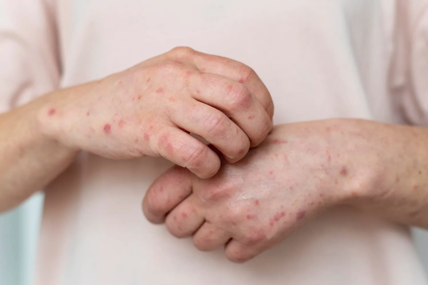 ALT: imagem de uma pessoa com herpes-zóster.