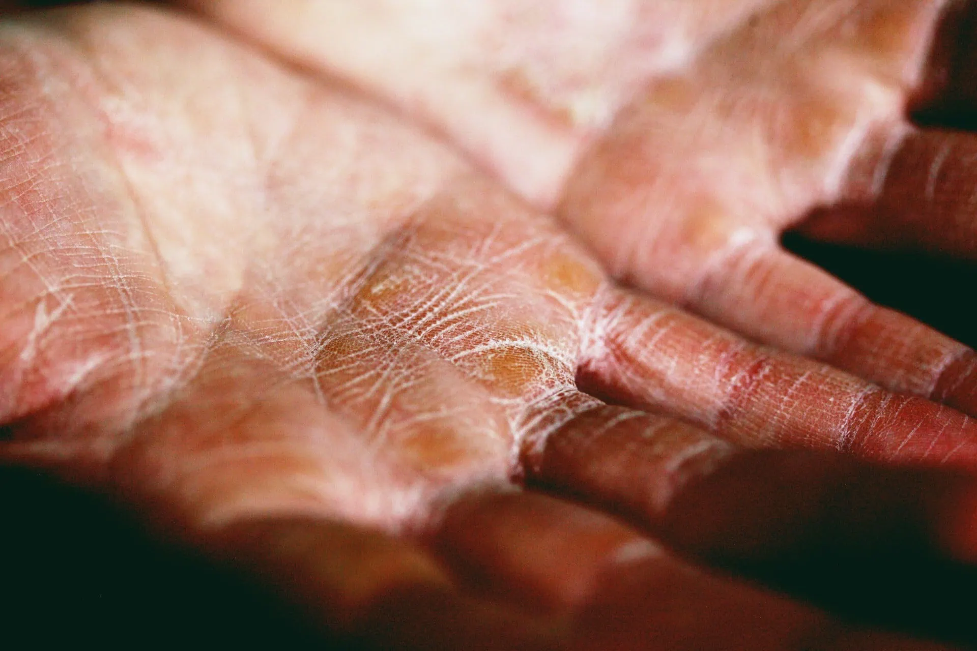 esclerodermia-unsplash ALT: imagem mostra close da palma de duas mãos, lado a lado, com a luz do sol iluminando partes endurecidas da pele.