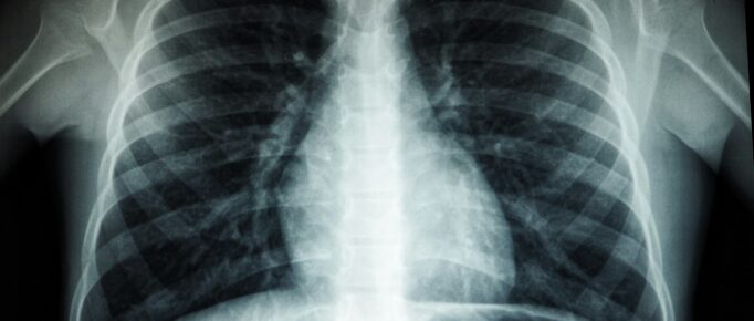 ALT: radiografia de tórax mostra opacidade próxima em ambos os pulmões, sinal de pneumonia nos lobos (parte central da imagem).