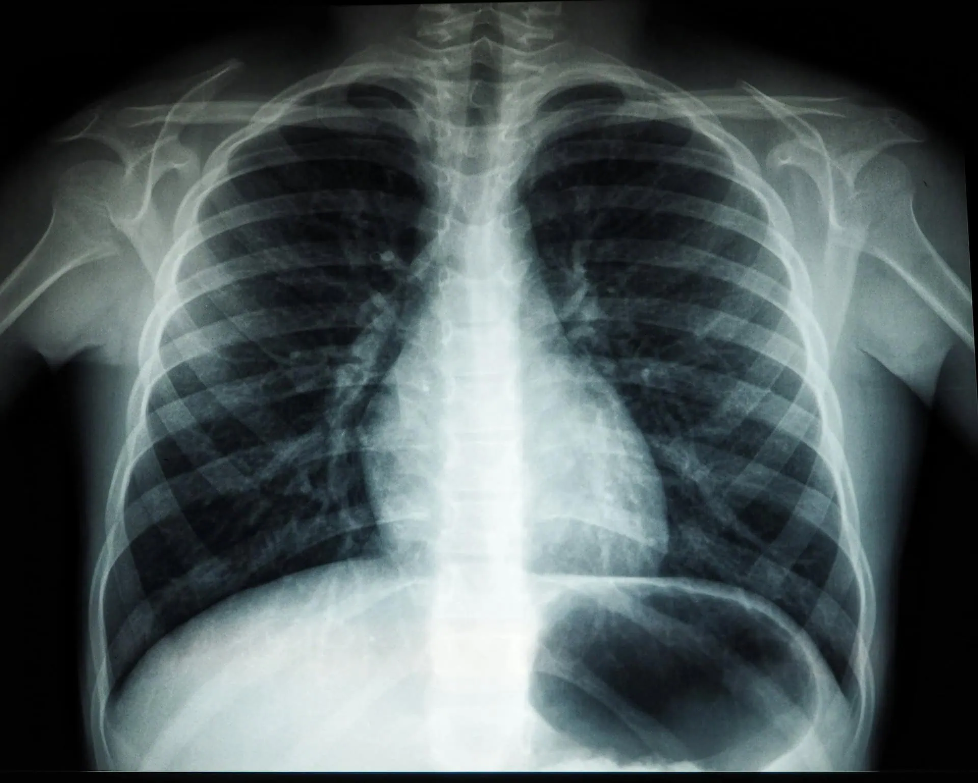 ALT: radiografia de tórax mostra opacidade próxima em ambos os pulmões, sinal de pneumonia nos lobos (parte central da imagem).